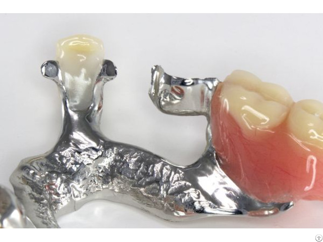 3d Printed Occlusal Splint Orthodontic Clear Aligner