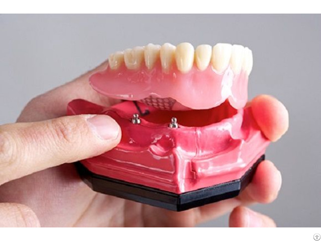 Crowns And Bridge Ceramics Dental Lab North Miami Beach