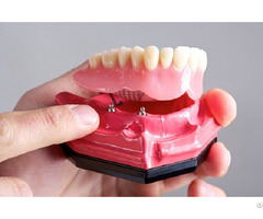 Crowns And Bridge Ceramics Dental Lab North Miami Beach