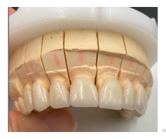 Zirconia Crowns