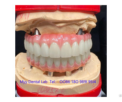 Oem Implant Zirconia Dental Crown Fixed Bridge
