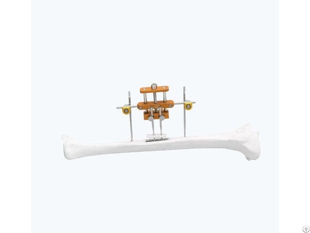 Tibia Transverse Bone Transport System