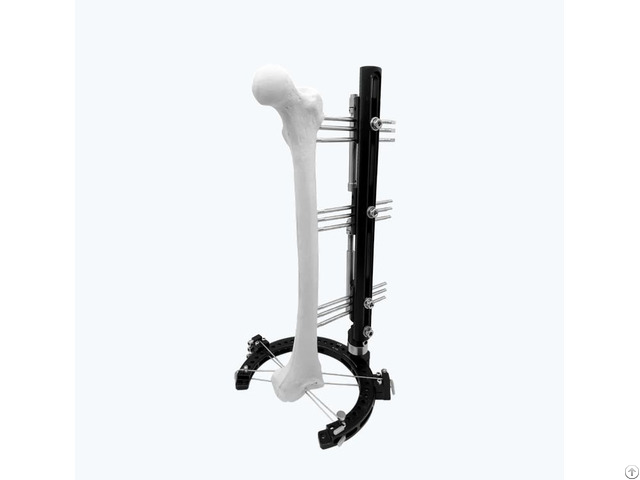 Hybrid Fixator Assembly For Reconstruction