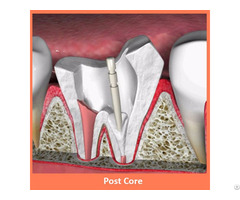 Dental Post Core