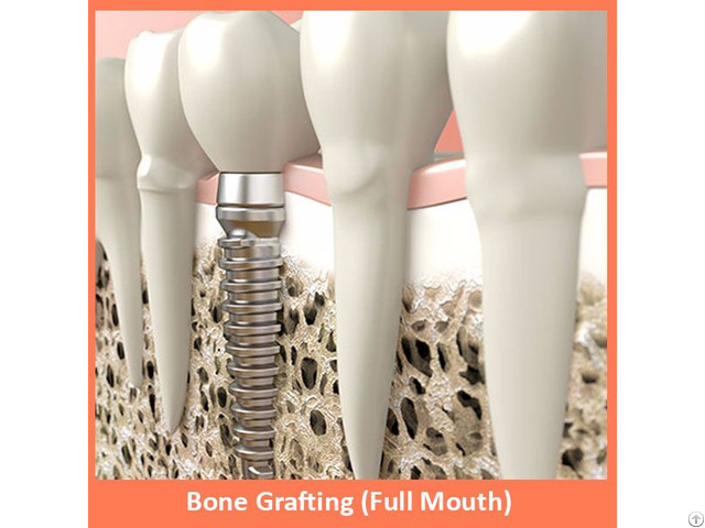 Bone Grafting Full Mouth