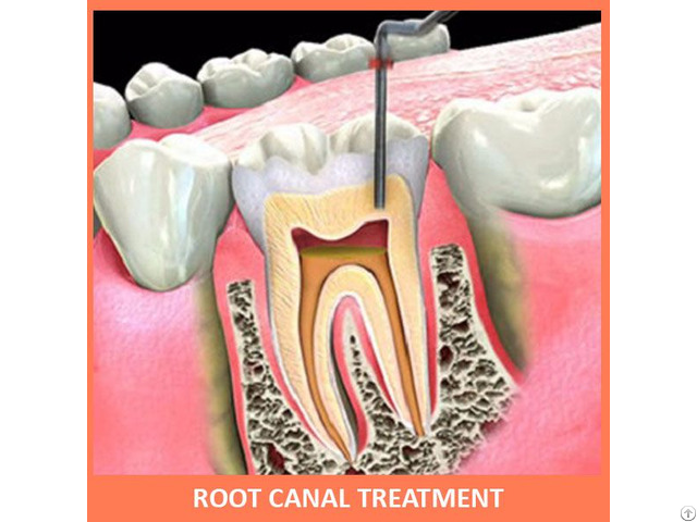 Root Canal Treatment Rct