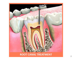 Root Canal Treatment Rct