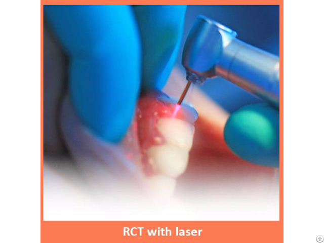 Root Canal Treatment With Laser