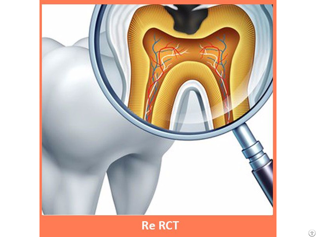 Re Root Canal Treatment