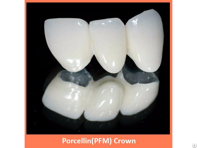 Porcellin Pfm Crown