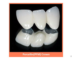 Porcellin Pfm Crown