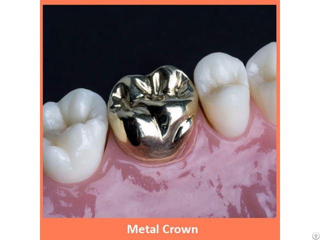 Dental Metal Crown