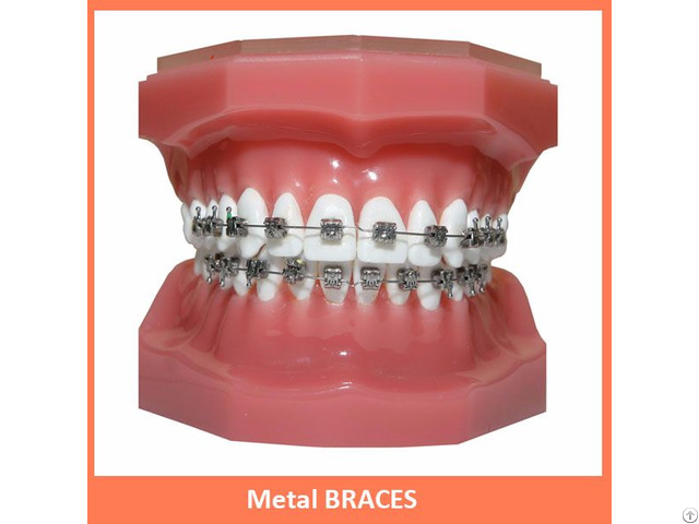 Metal Braces