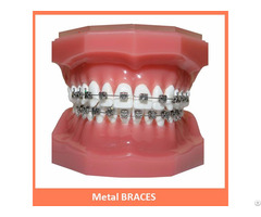 Metal Braces