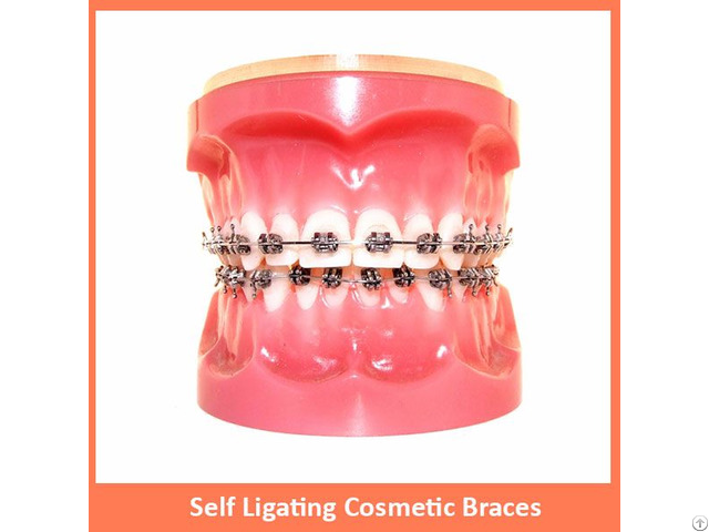 Self Ligating Cosmetic Braces