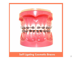 Self Ligating Cosmetic Braces