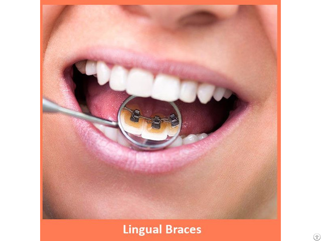 Lingual Braces