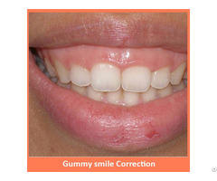 Gummy Smile Correction