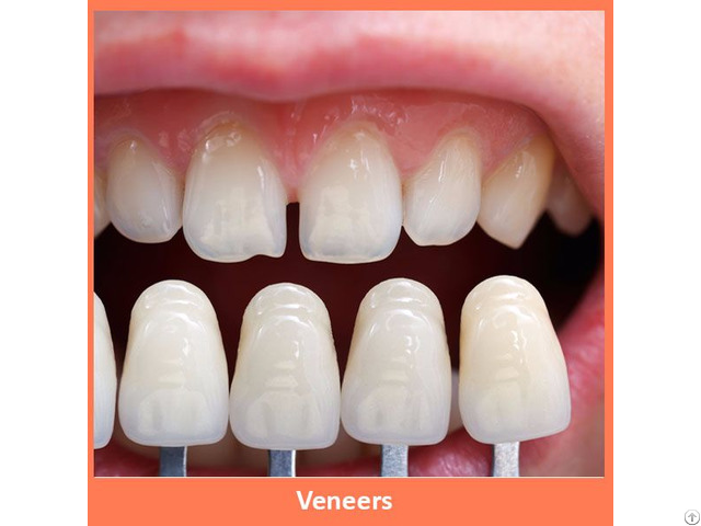 Dental Veneers