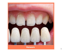 Dental Veneers